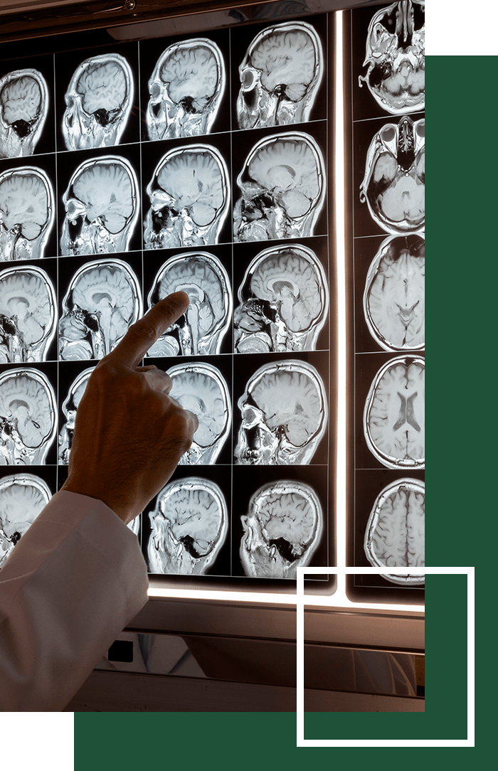 Indianapolis Traumatic Brain Injury Lawyer